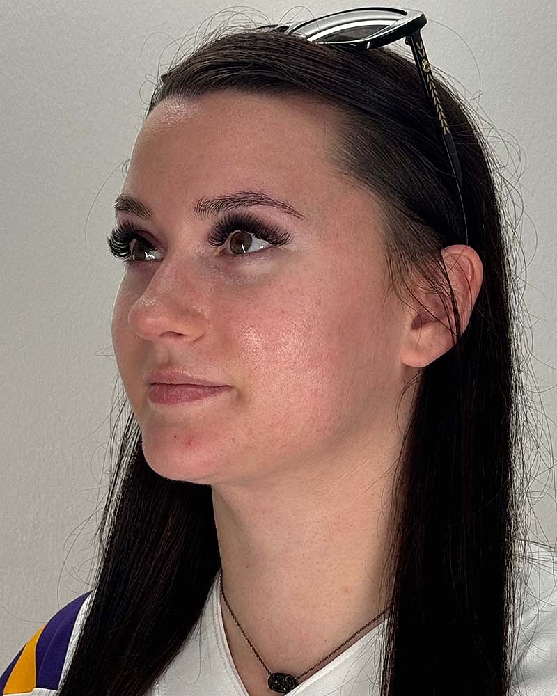 Chin Liposuction Before & After
