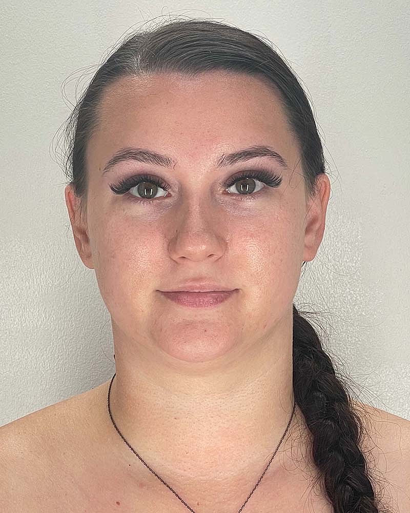 Chin Liposuction Before & After