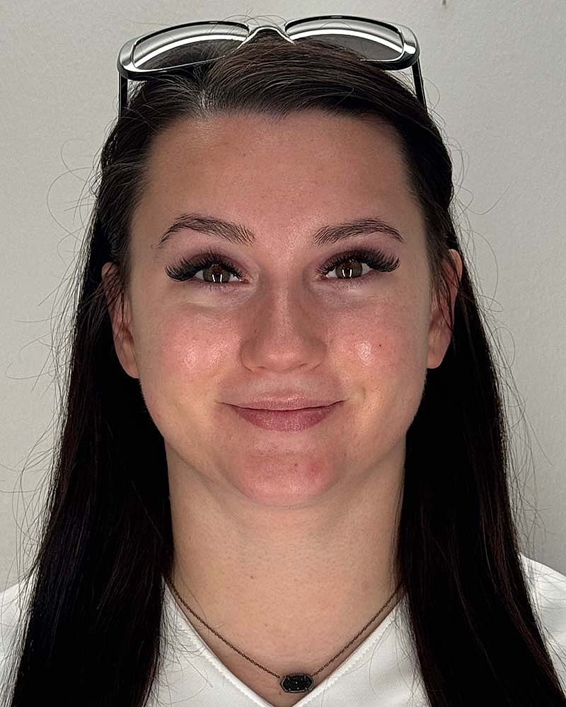 Chin Liposuction Before & After
