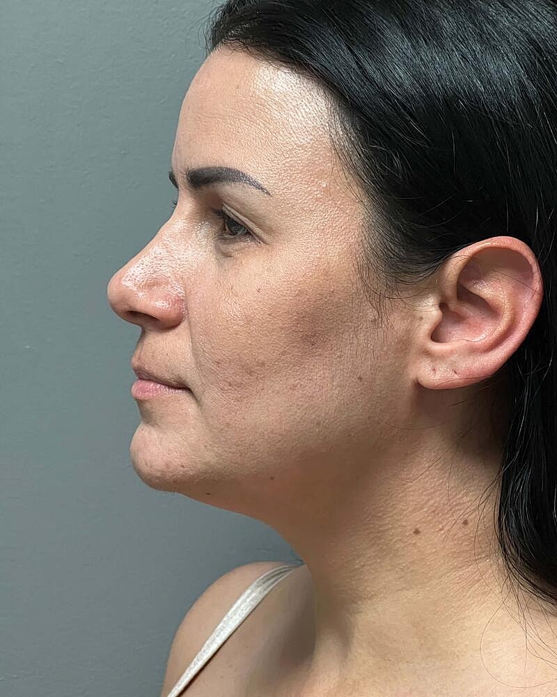 Chin Liposuction Before & After