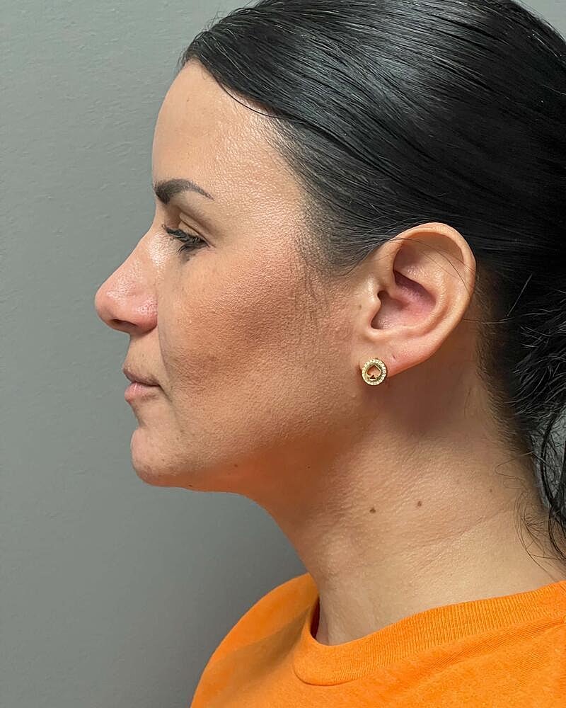 Chin Liposuction Before & After