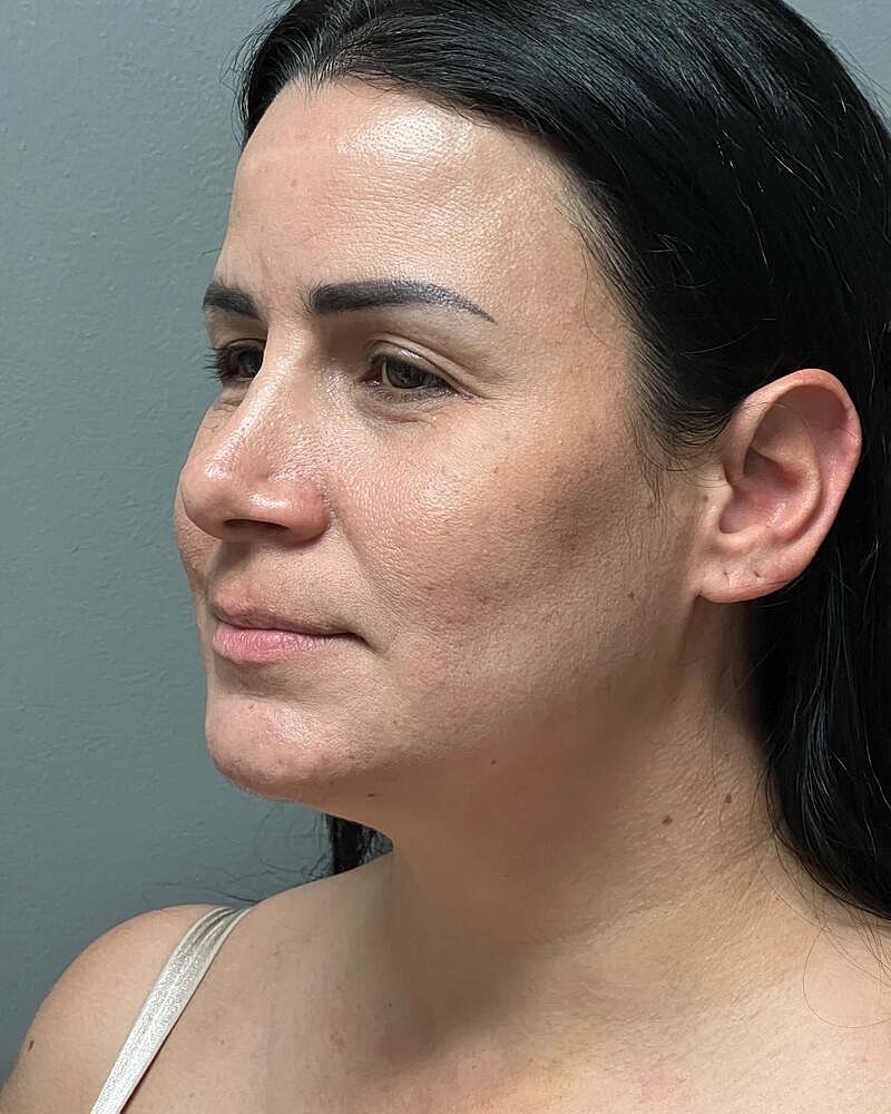 Chin Liposuction Before & After