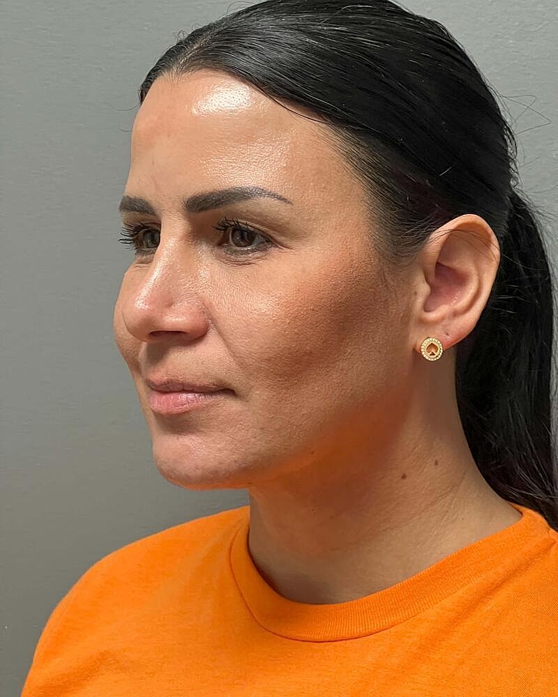 Chin Liposuction Before & After