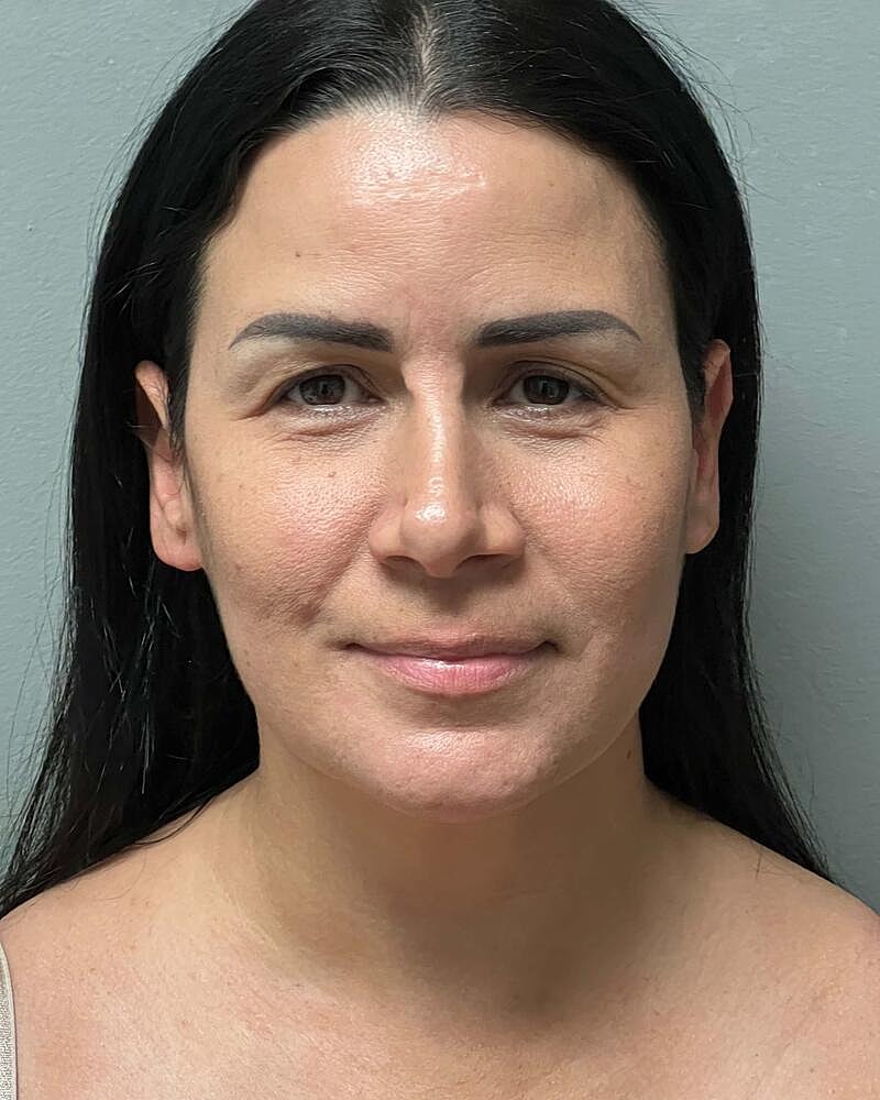 Chin Liposuction Before & After