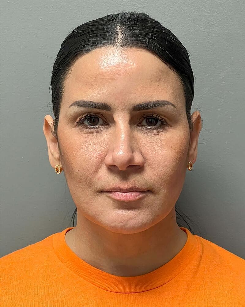 Chin Liposuction Before & After