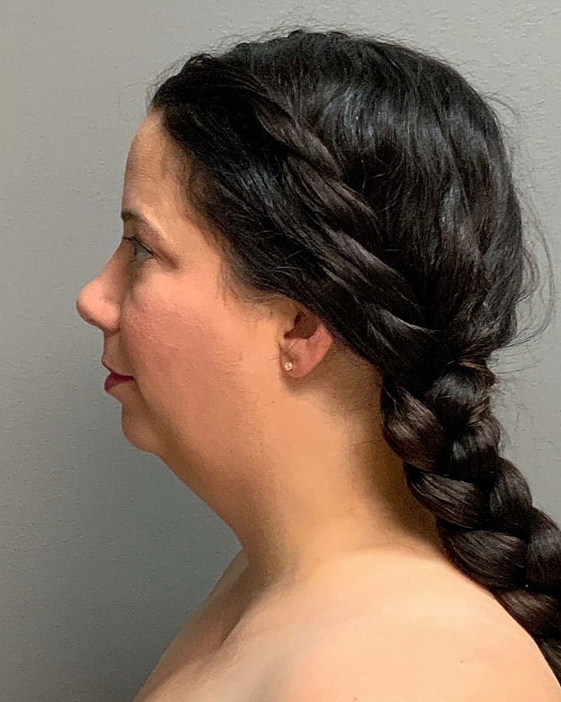 Chin Liposuction Before & After