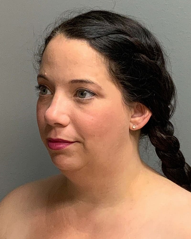 Chin Liposuction Before & After