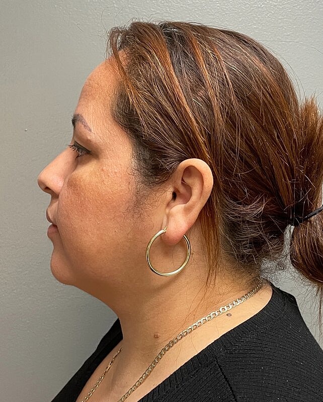 Chin Liposuction Before & After