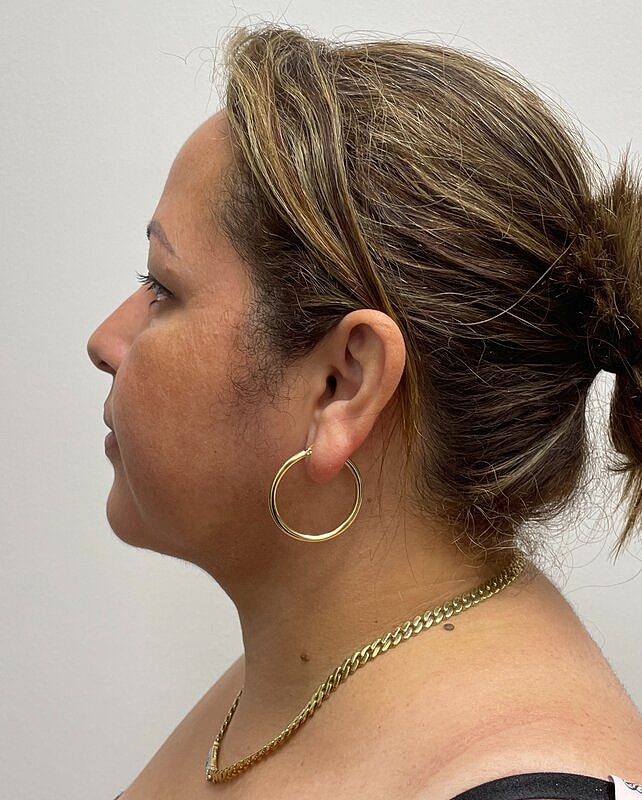 Chin Liposuction Before & After