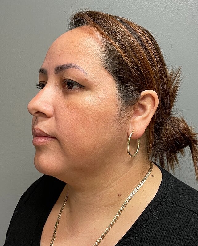 Chin Liposuction Before & After