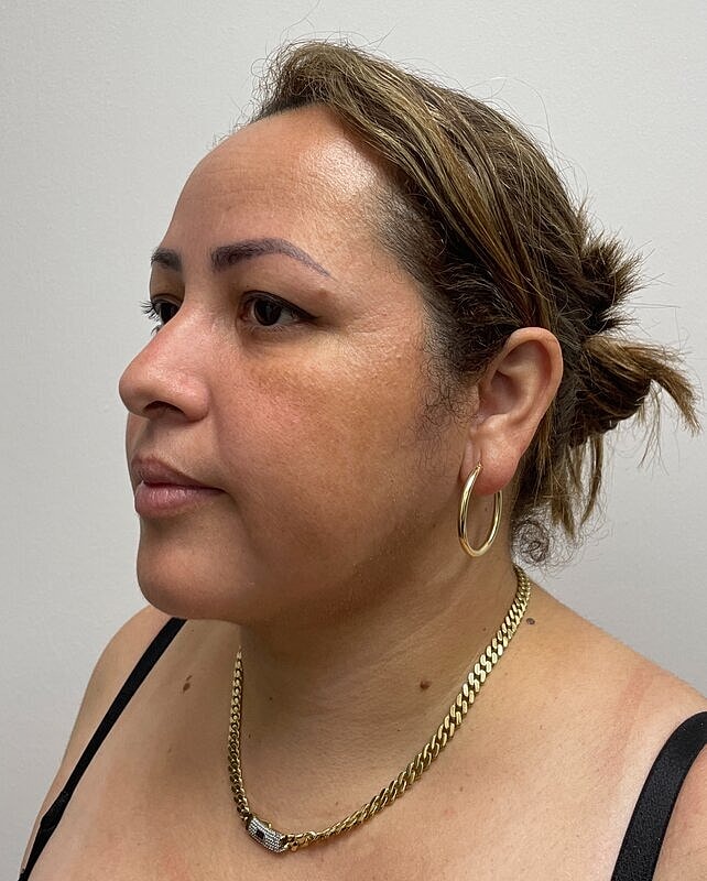 Chin Liposuction Before & After