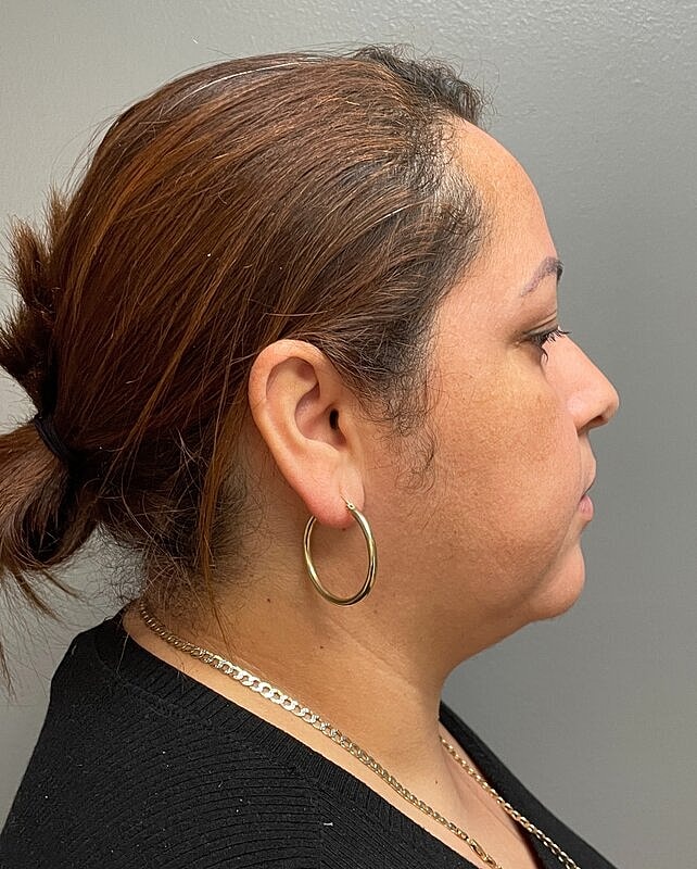 Chin Liposuction Before & After