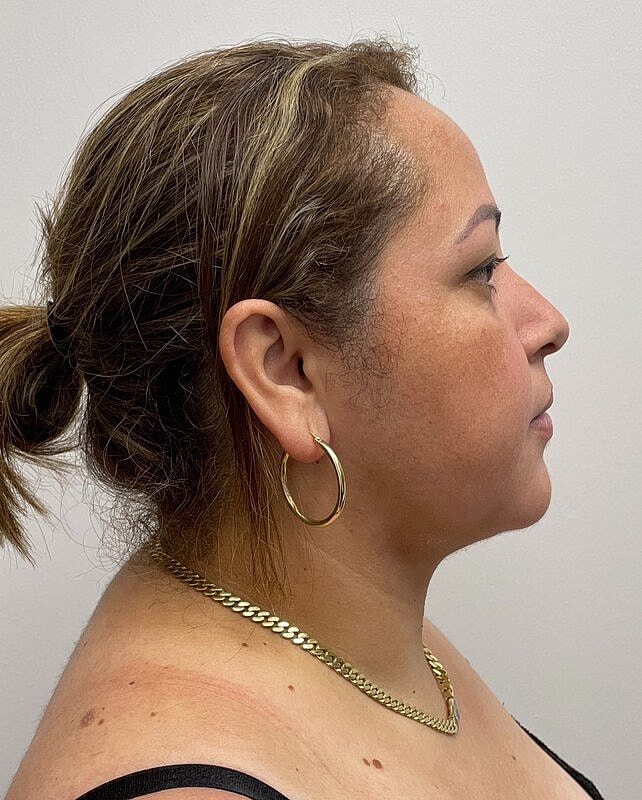Chin Liposuction Before & After