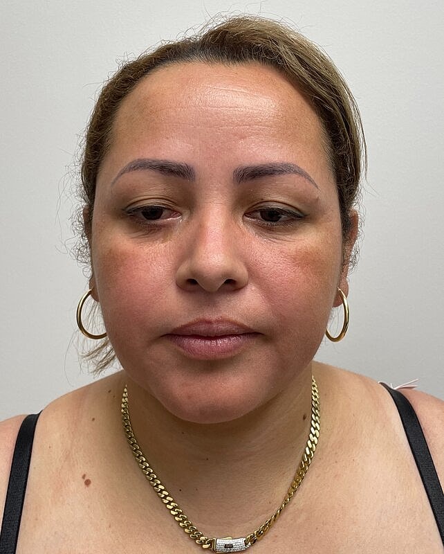 Chin Liposuction Before & After