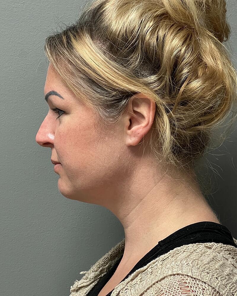 Chin Liposuction Before & After