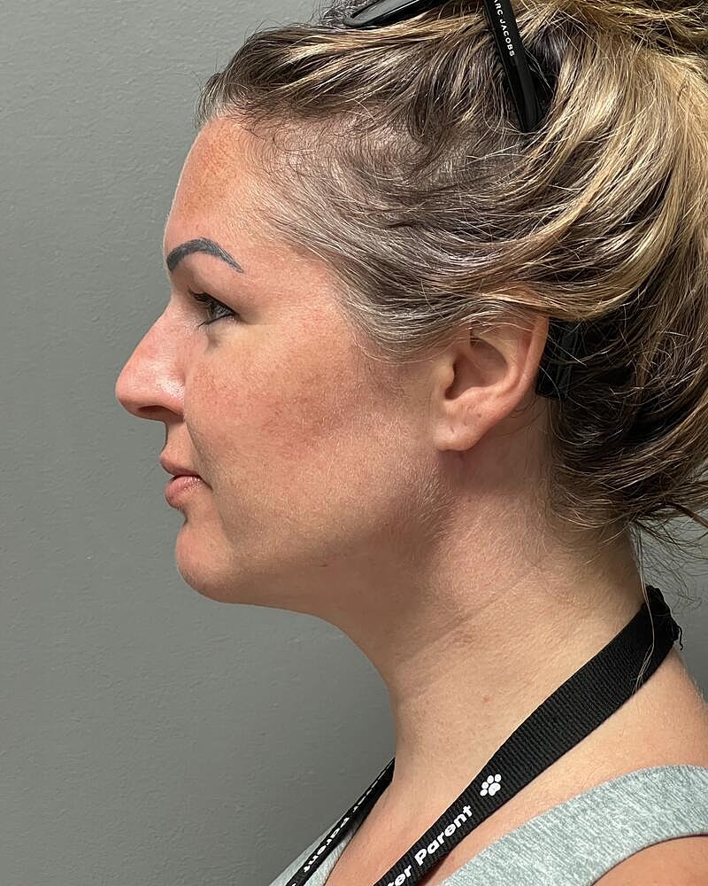 Chin Liposuction Before & After