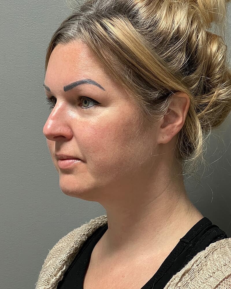 Chin Liposuction Before & After