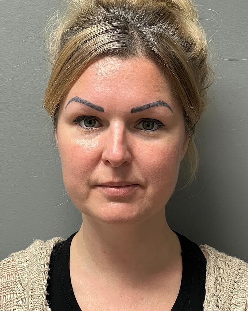 Chin Liposuction Before & After