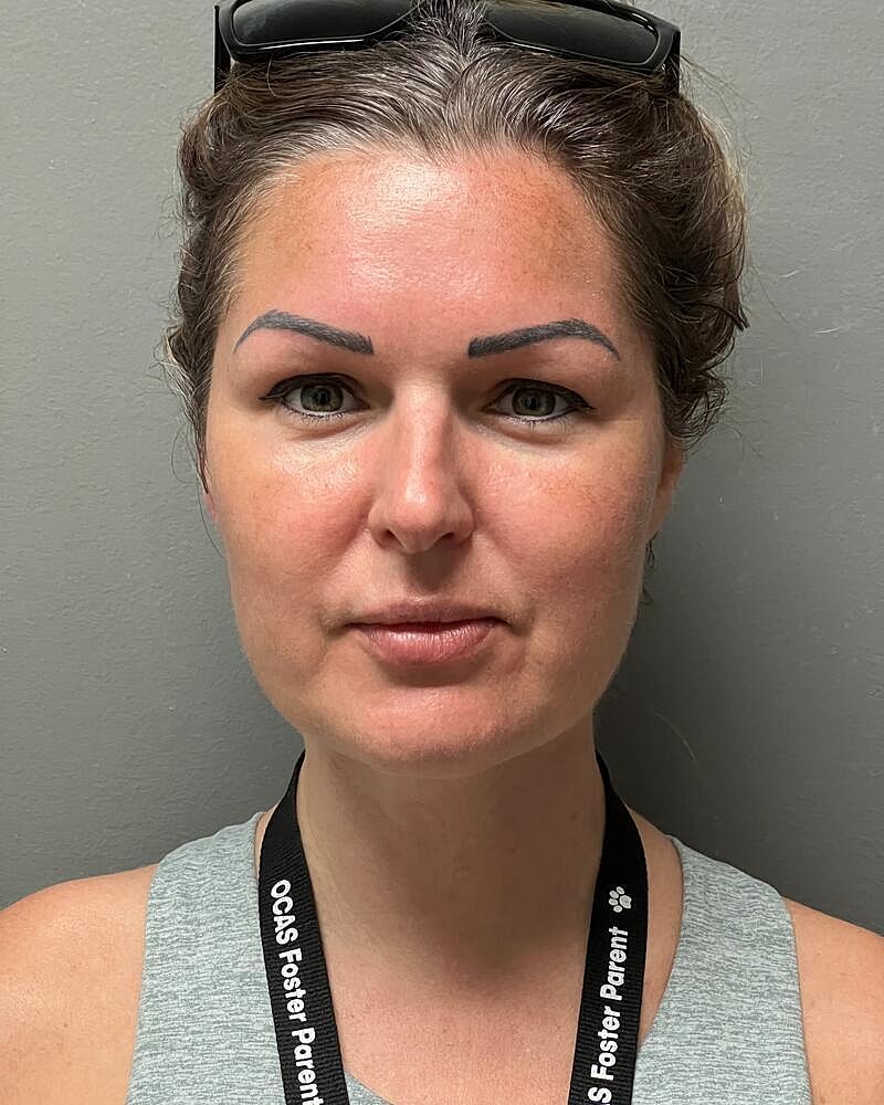 Chin Liposuction Before & After