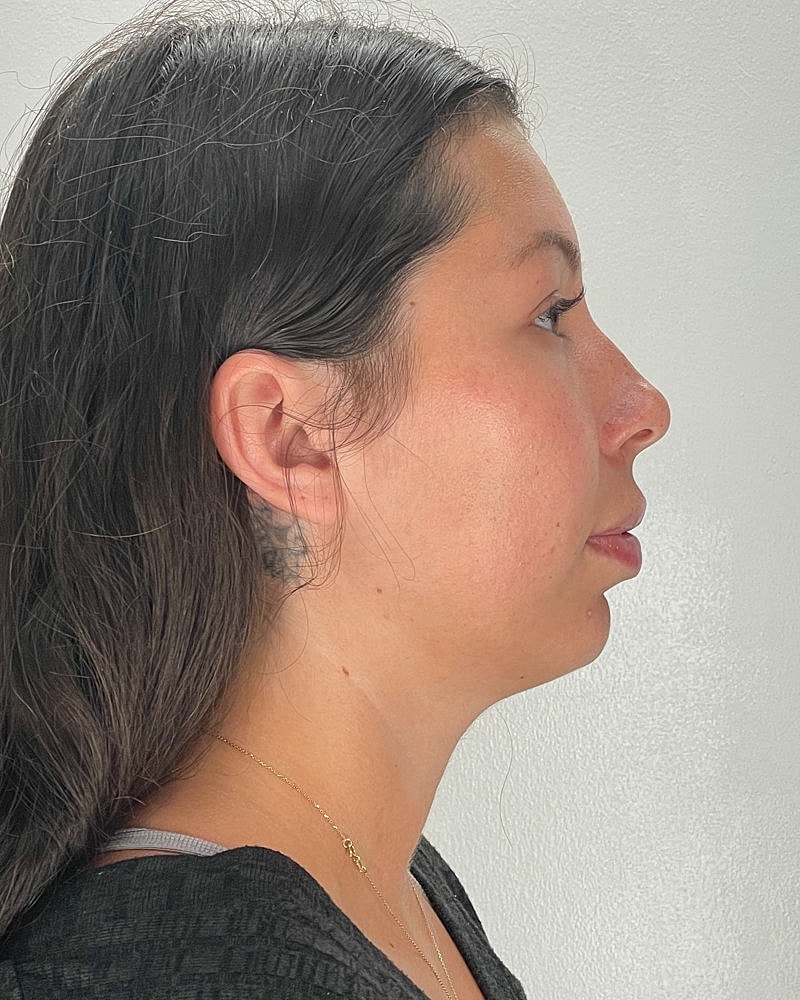 Chin Liposuction Before & After