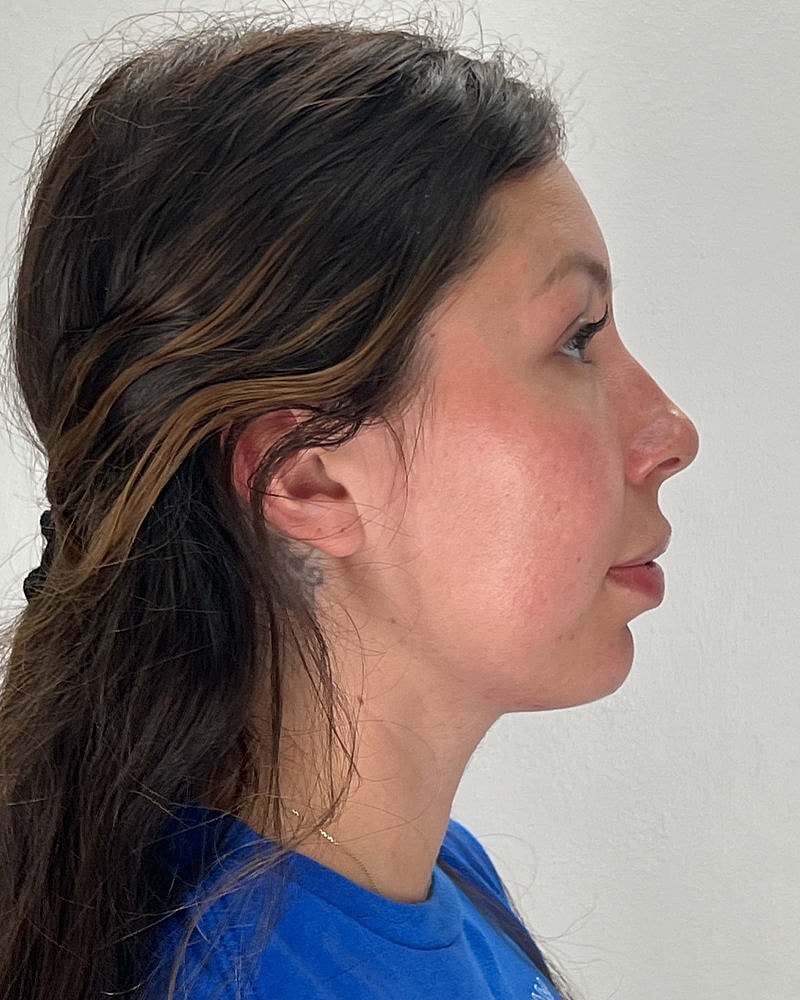 Chin Liposuction Before & After