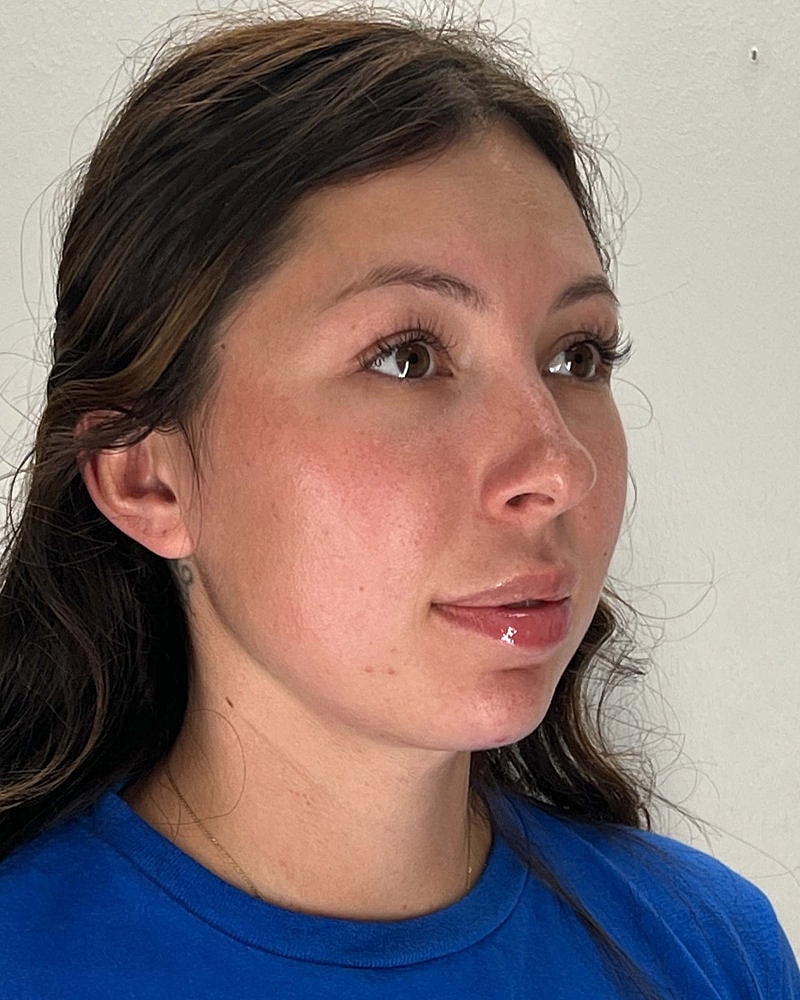 Chin Liposuction Before & After