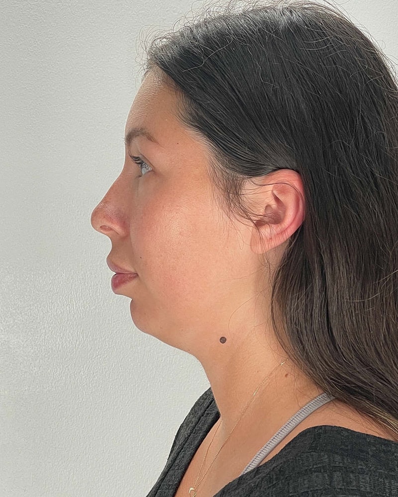 Chin Liposuction Before & After
