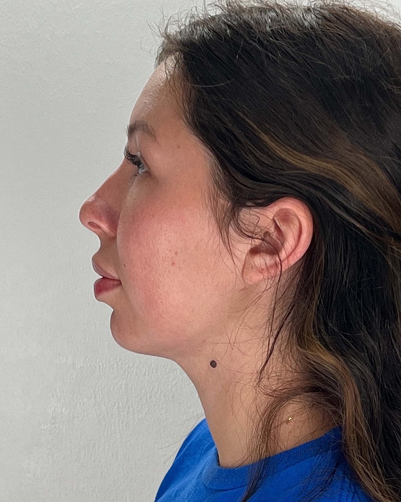 Chin Liposuction Before & After