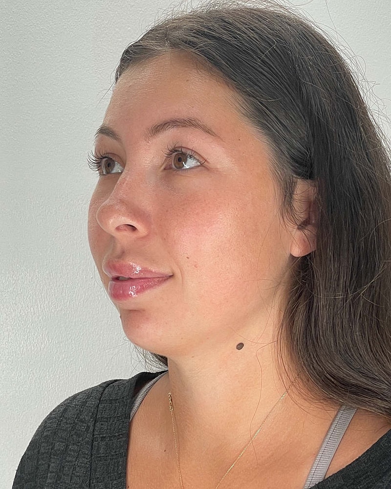 Chin Liposuction Before & After