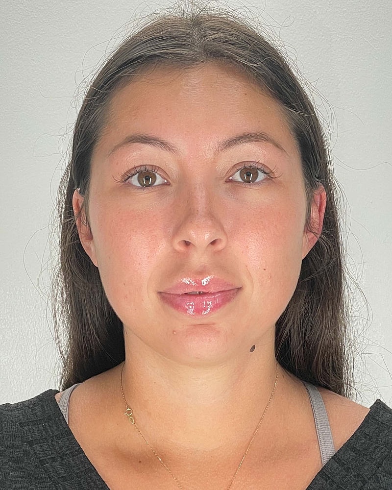 Chin Liposuction Before & After
