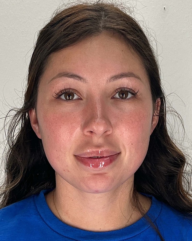 Chin Liposuction Before & After
