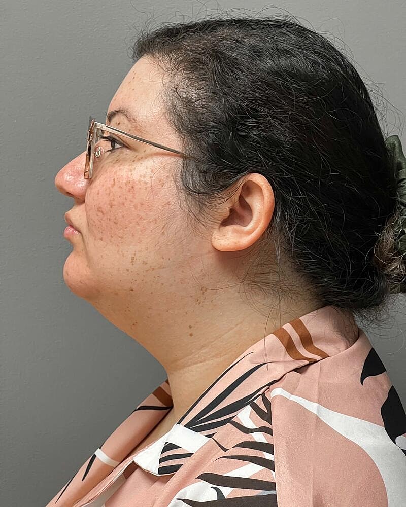 Chin Liposuction Before & After