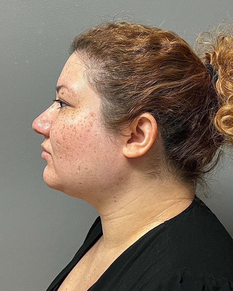 Chin Liposuction Before & After