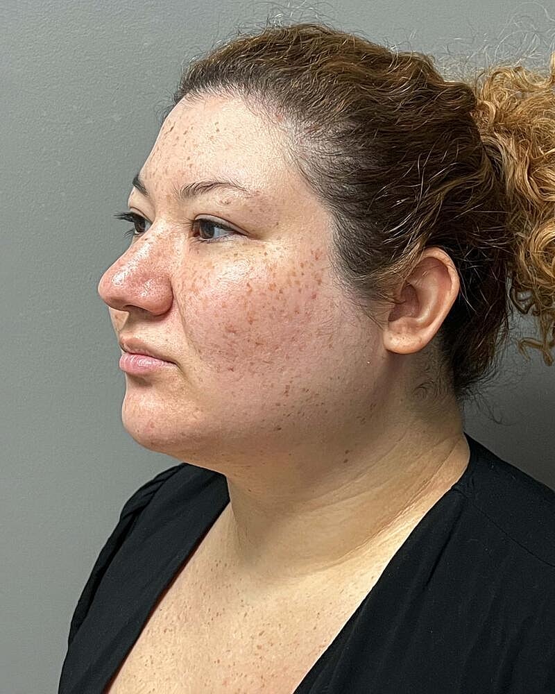 Chin Liposuction Before & After