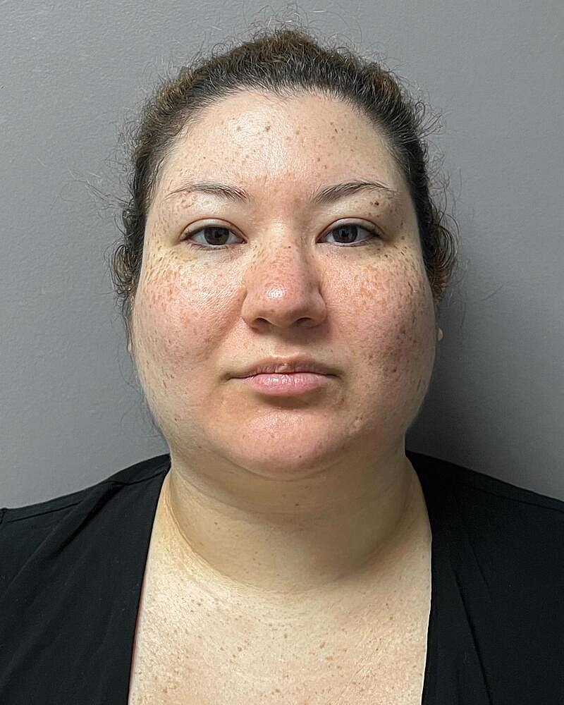 Chin Liposuction Before & After