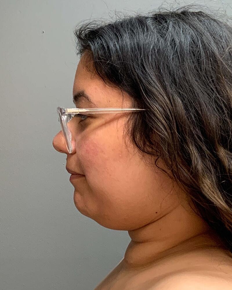 Chin Liposuction Before & After