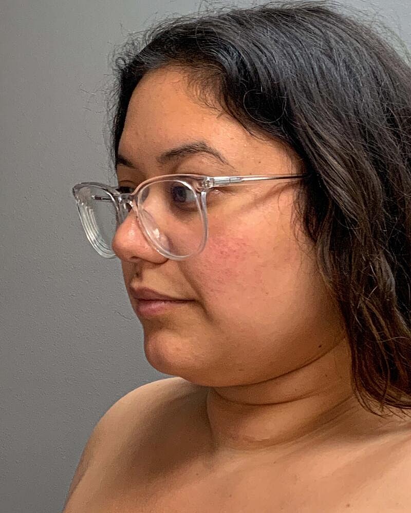 Chin Liposuction Before & After