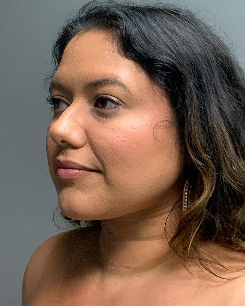 Chin Liposuction Before & After