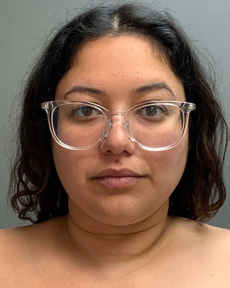 Chin Liposuction Before & After