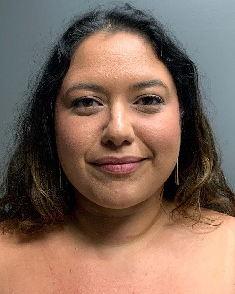 Chin Liposuction Before & After