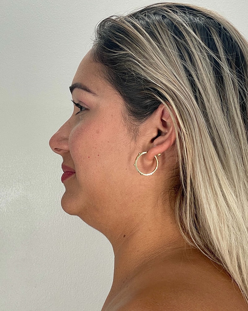 Chin Liposuction Before & After