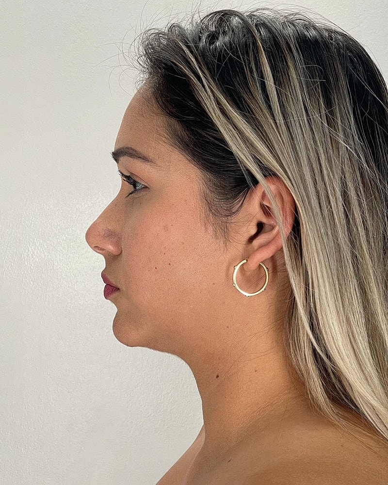 Chin Liposuction Before & After