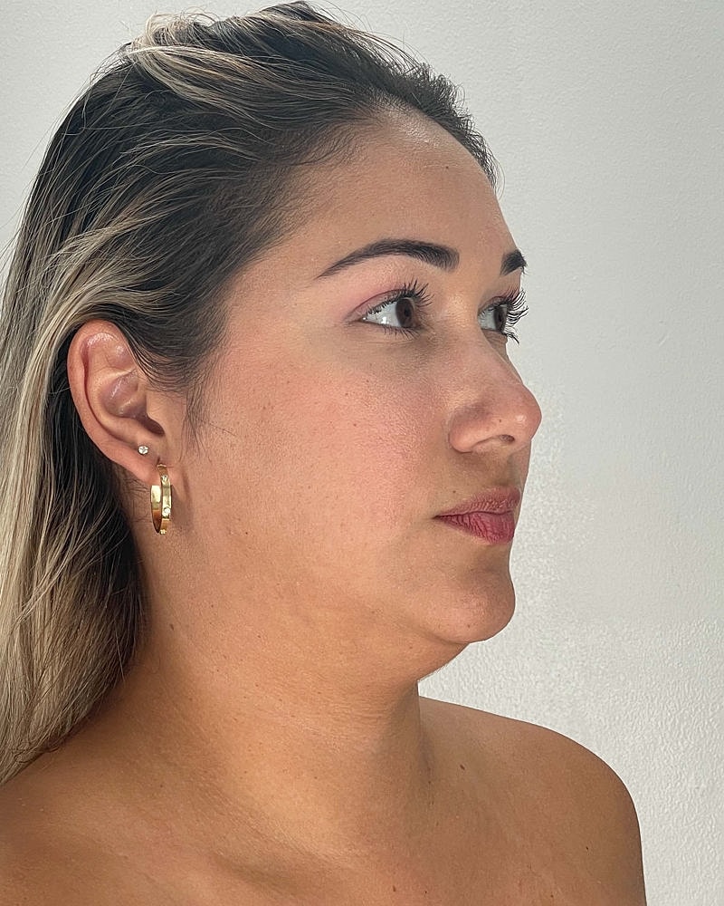 Chin Liposuction Before & After