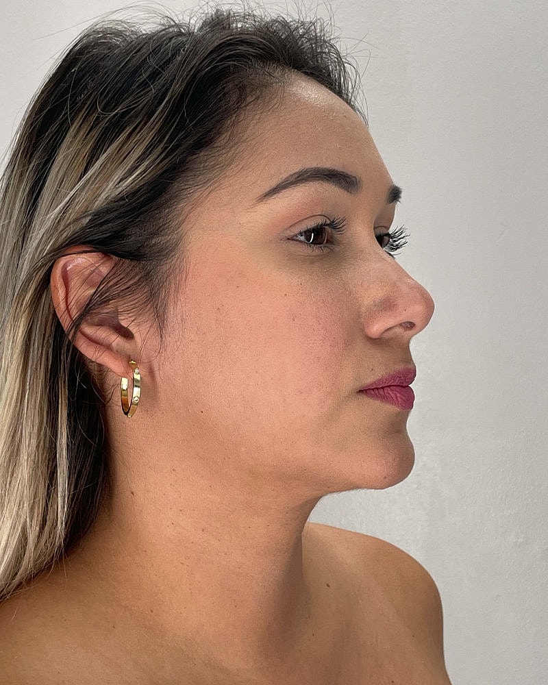 Chin Liposuction Before & After