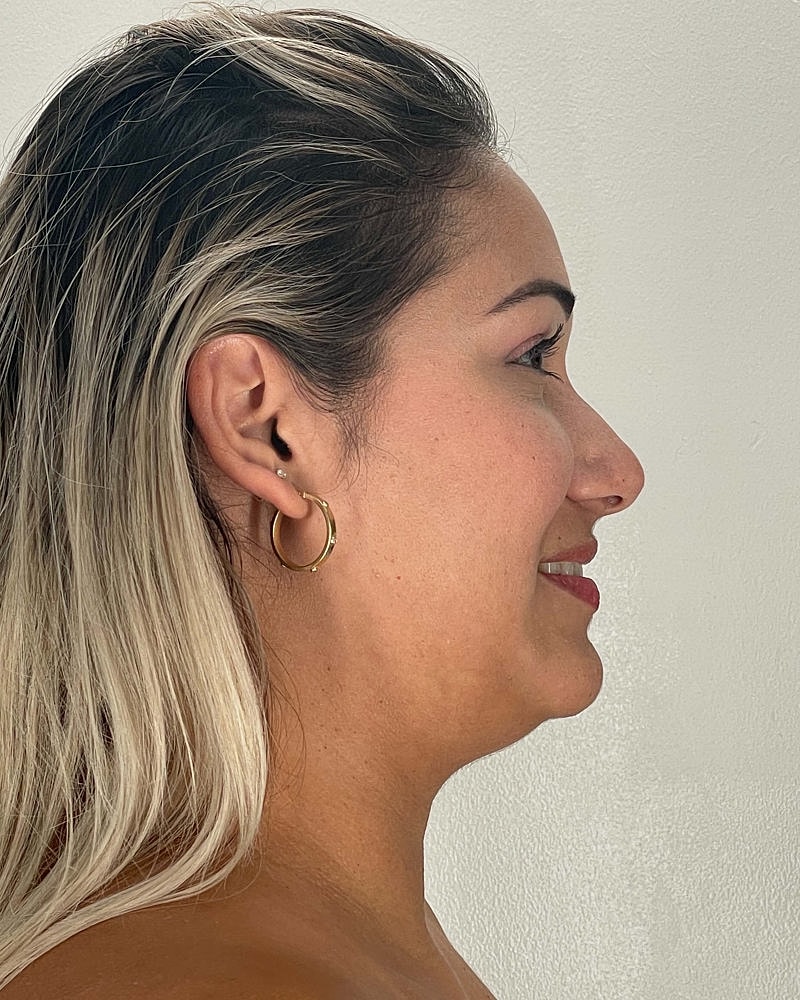 Chin Liposuction Before & After