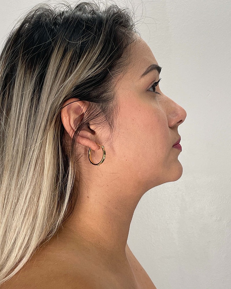 Chin Liposuction Before & After