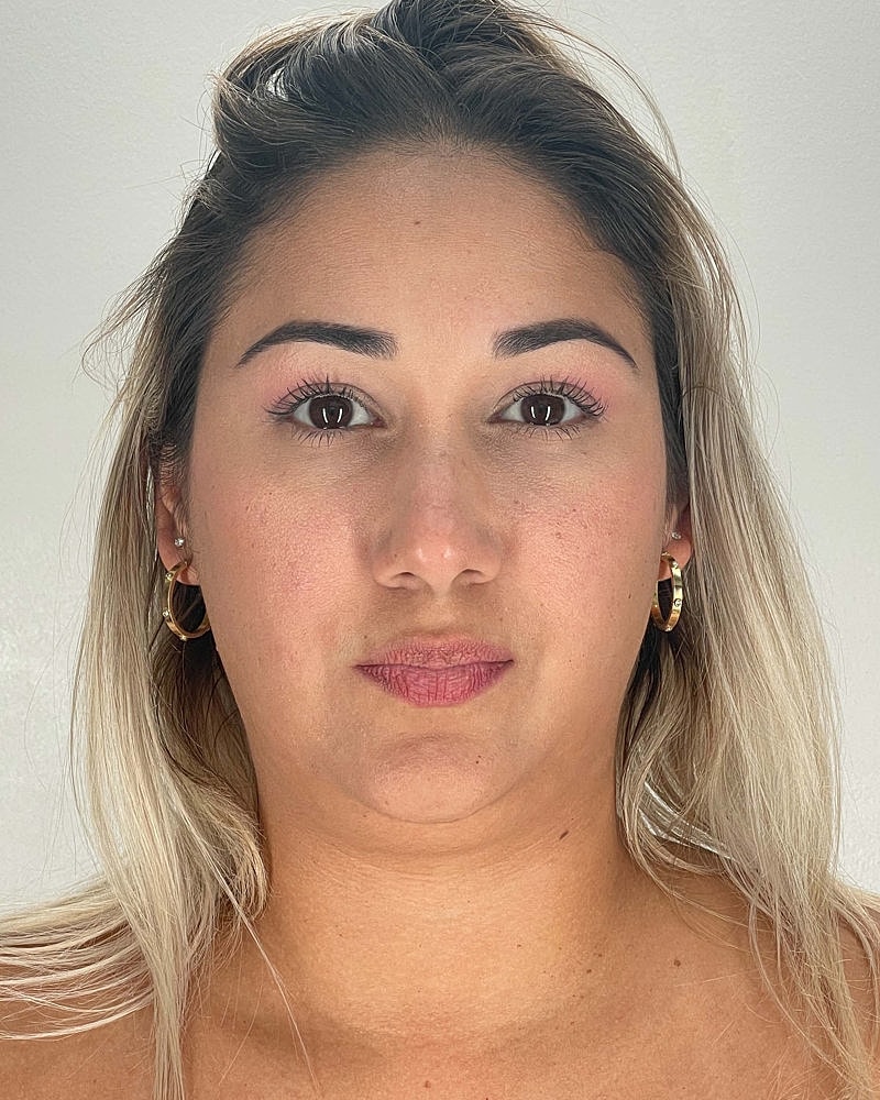 Chin Liposuction Before & After