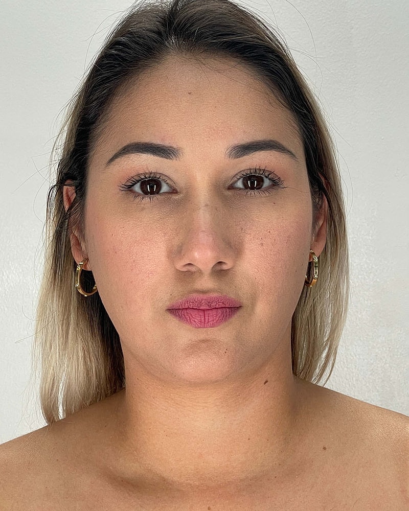Chin Liposuction Before & After