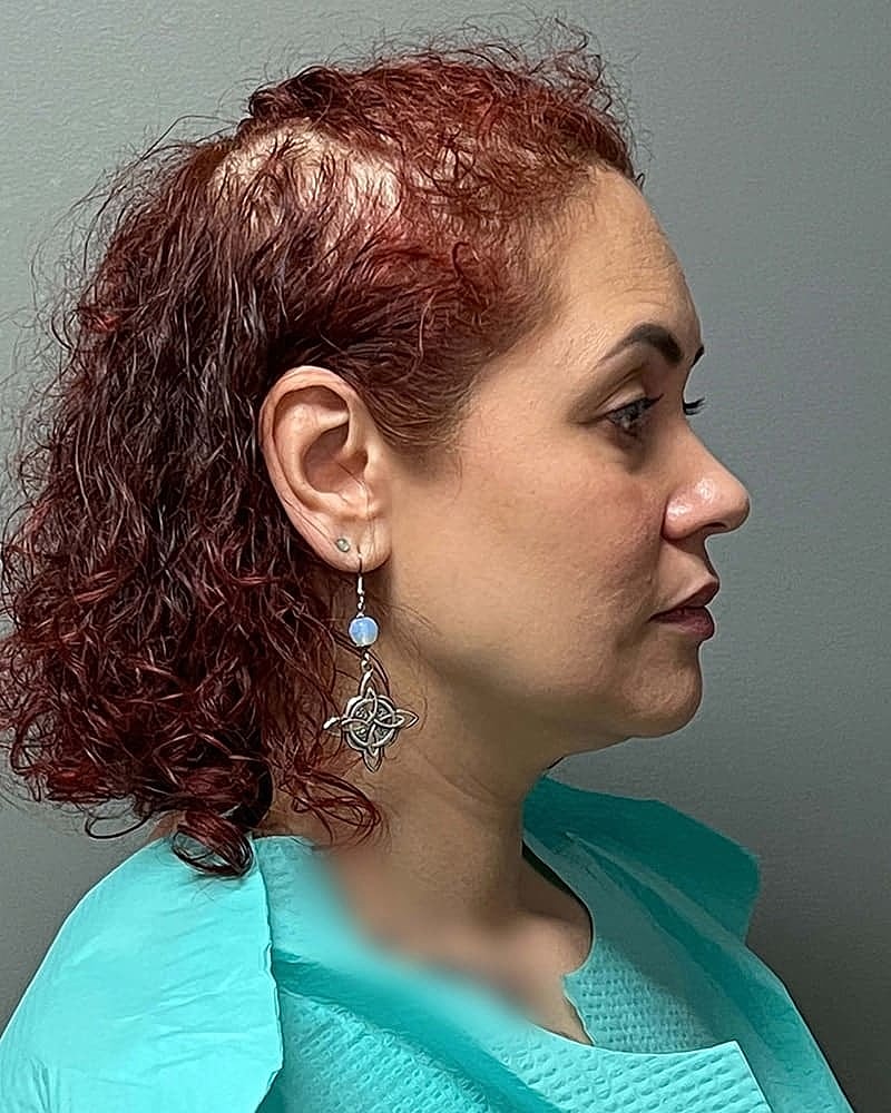 Chin Liposuction Before & After