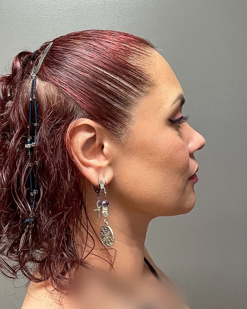 Chin Liposuction Before & After